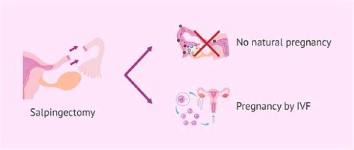 Bilateral Salpingectomy Pregnancy