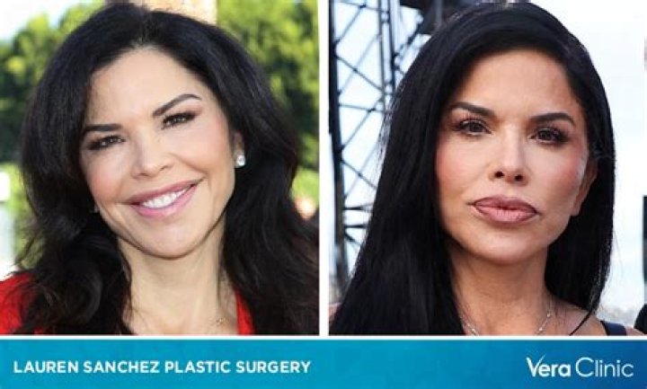 Lauren Sanchez Before Surgery Did She Underwent Plastic Surgery?