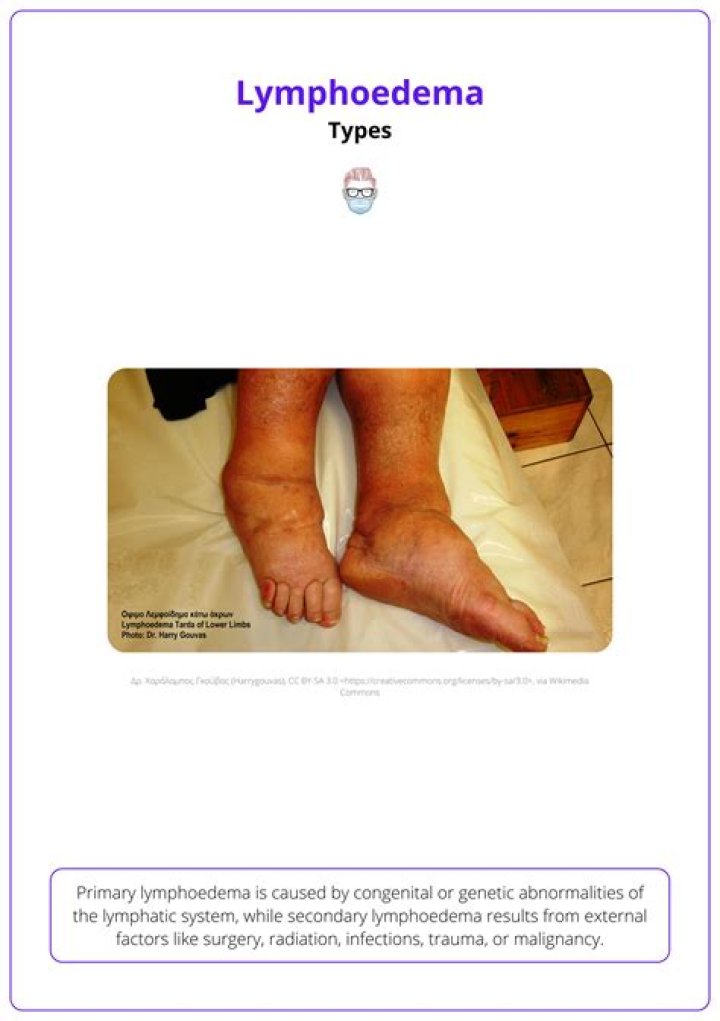 Living With Lymphoedema: A Woman's Journey